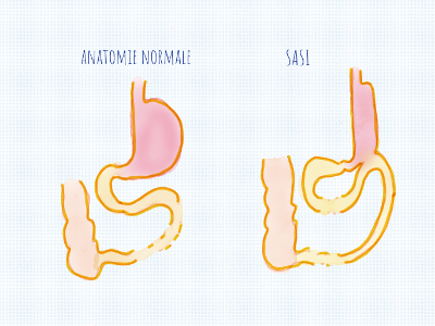 Représentation de la SASI, nouvelle chirurgie de l'obésité