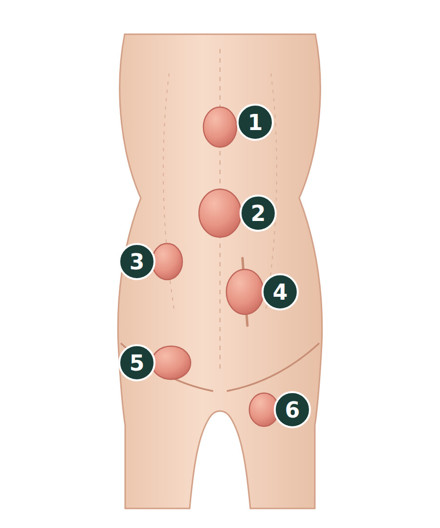 Sch&eacute;ma num&eacute;rot&eacute; des six hernies de la paroi abdominale : &eacute;pigastrique, ombilicale, de Spiegel, &eacute;ventration, inguinale et crurale