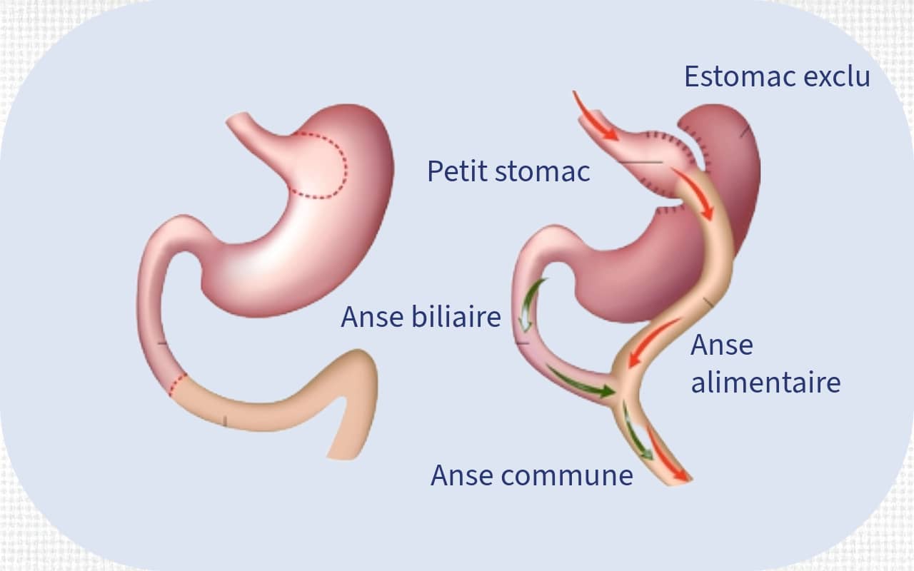 Bypass gastrique réalisé par un chirurgien de l'obésité à Liège et à Bruxelles