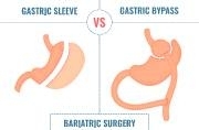 Sleeve ou Bypass : quelle chirurgie de l’obésité choisir en Belgique ?