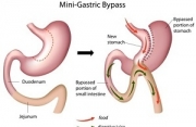 De mini gastric bypass: een nieuwere operatie die zijn waarde heeft bewezen