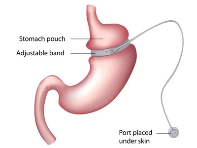 Adjustable gastric band 
