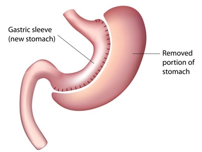 Sleeve Gastrectomie