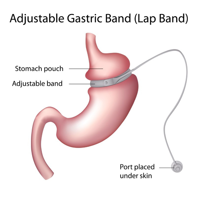 Gastric ring by an obesity surgeon in Liège/Brussels