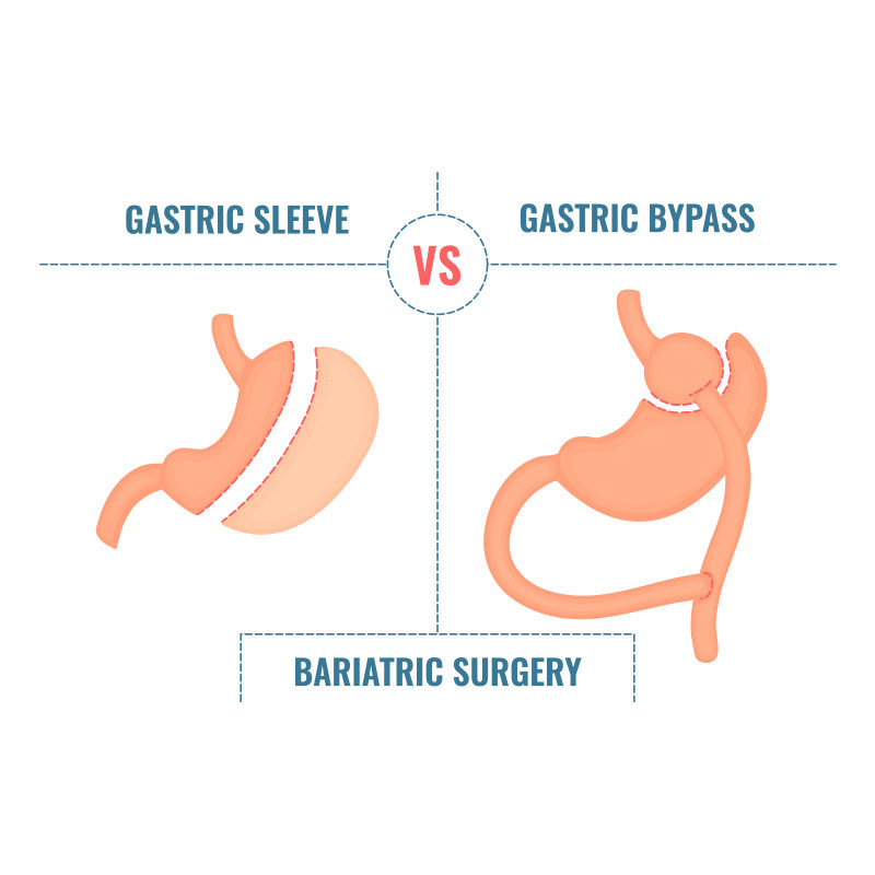 Bypass ou Sleeve : quel type de chirurgie de l’obésité choisir ?