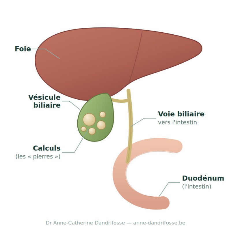 schéma de la vésicule biliaire et des calculs