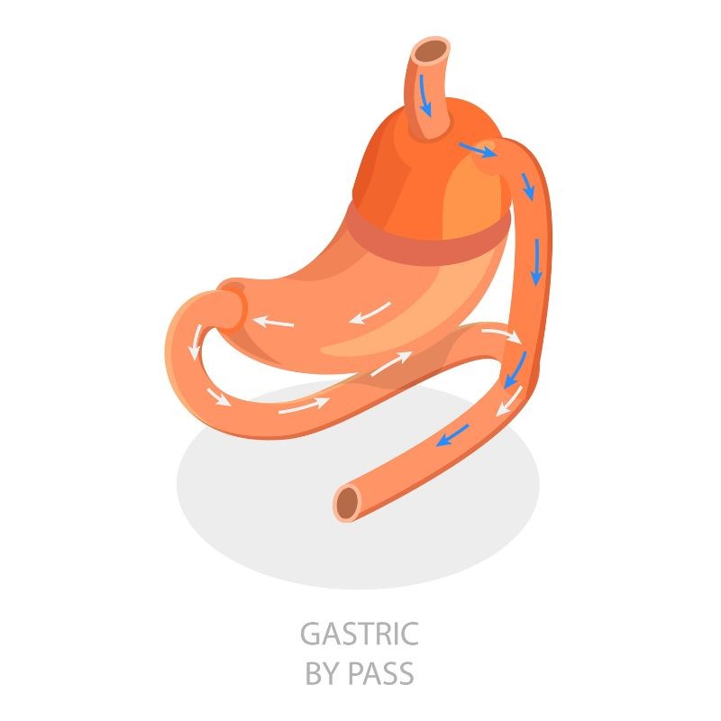 Conditions pour bénéficier d’un bypass gastrique à Liège.