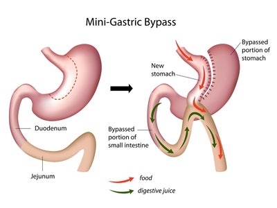 Bypass gastrique 
