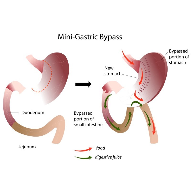 Gastrische Bypass door een obesitaschirurg in Brussel