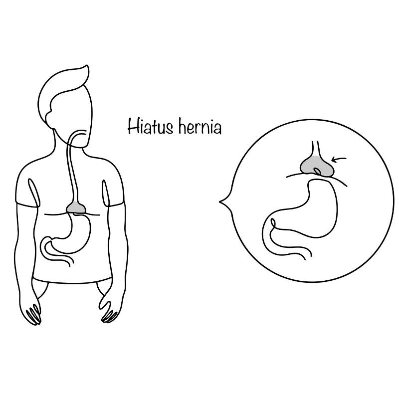 Hernie hiatale et reflux : quand opérer ? Bruxelles et Liège