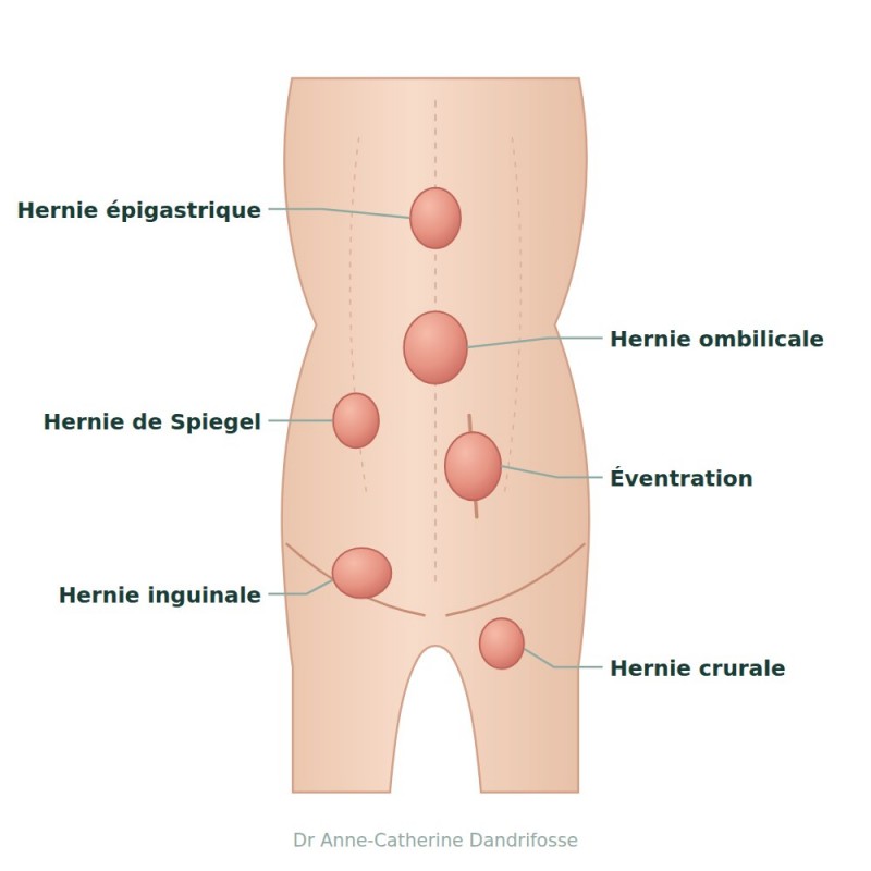 Schéma des différentes hernies de la paroi abdominale : ombilicale, inguinale, crurale, épigastrique et éventration