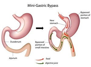 Wat is de mini bypass, die men uitvoert in Brussel ?