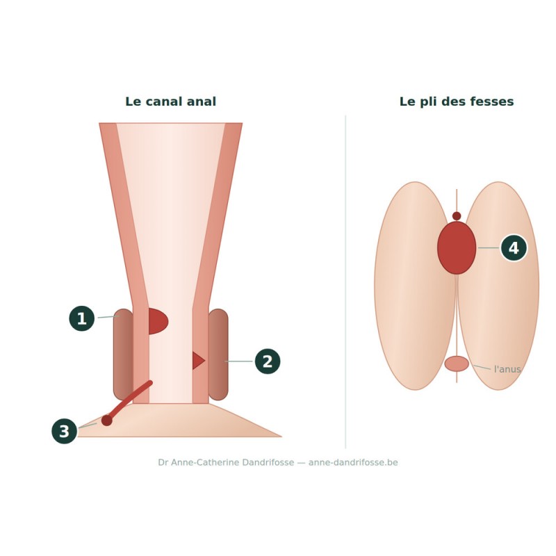 Schéma numéroté des affections proctologiques : hémorroïdes, fissure anale, fistule et kyste pilonidal