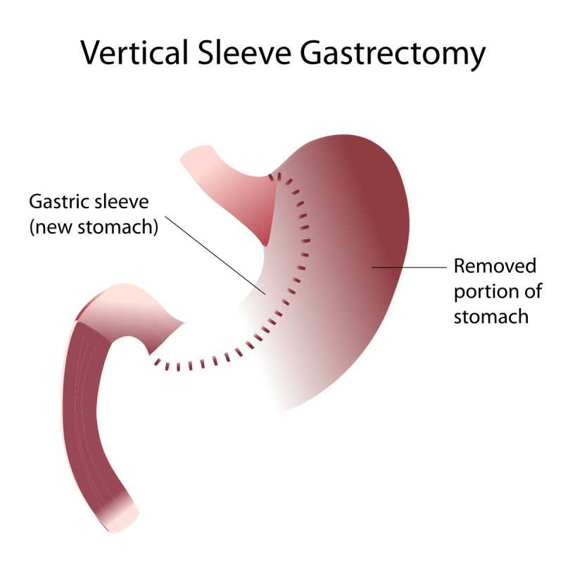 Sleeve gastrectomie door een obesitas chirurg in Brussel.