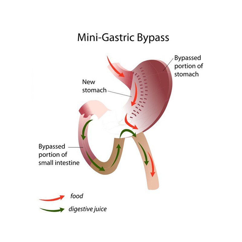 Types of surgery to treat obesity