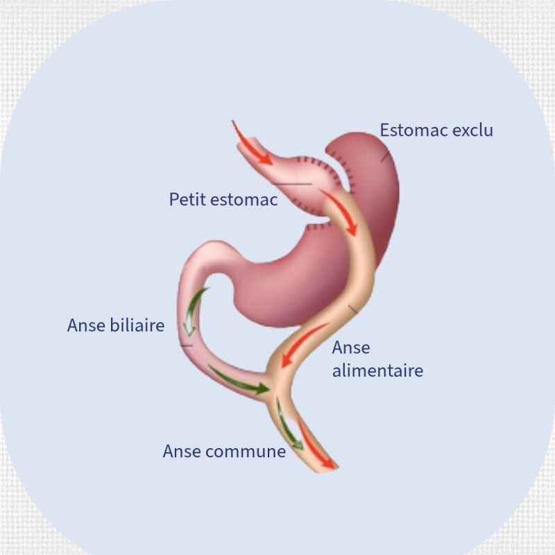 Types de chirurgie pour soigner l'obésité